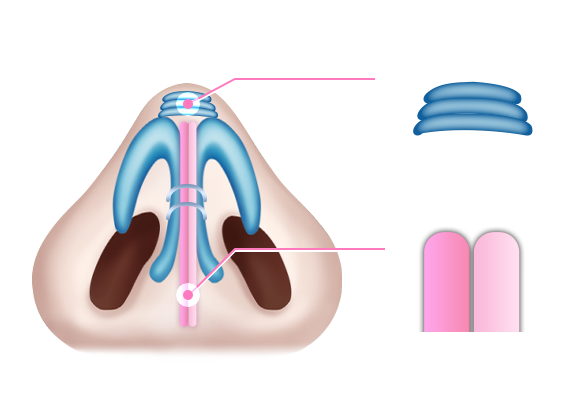 디에이 자가늑 코성형