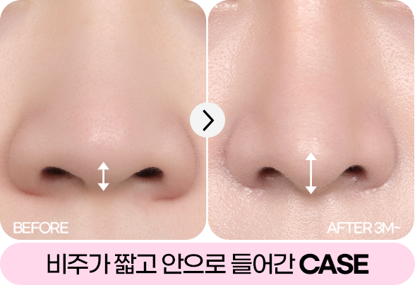 디에이 자가늑 코성형