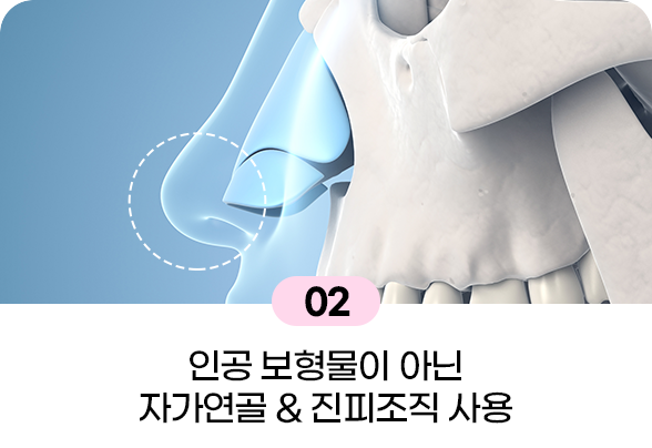 디에이 코끝성형