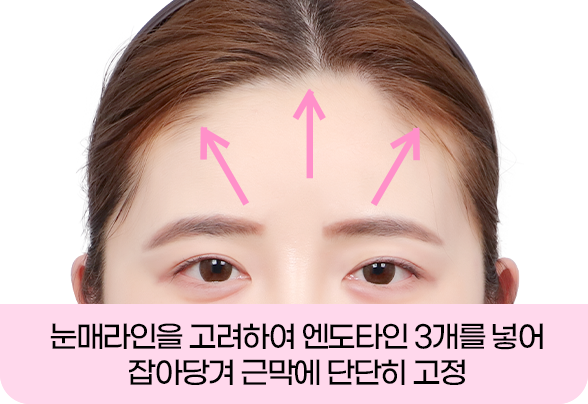 디에이 올아이 리프팅