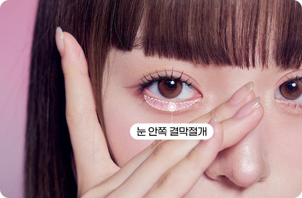 디에이 눈밑 지방재배치