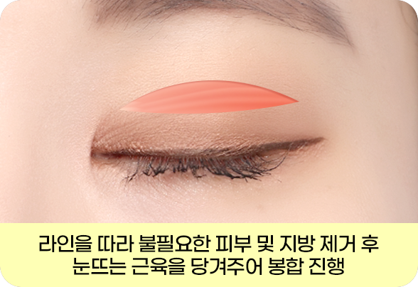 디에이 눈매 교정