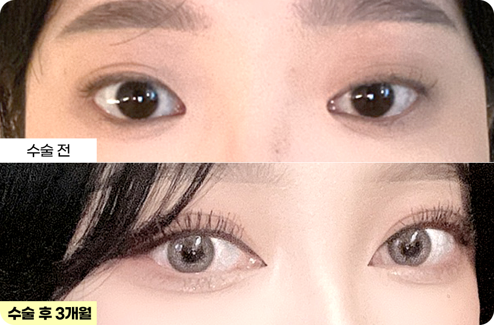 디에이 눈매 교정
