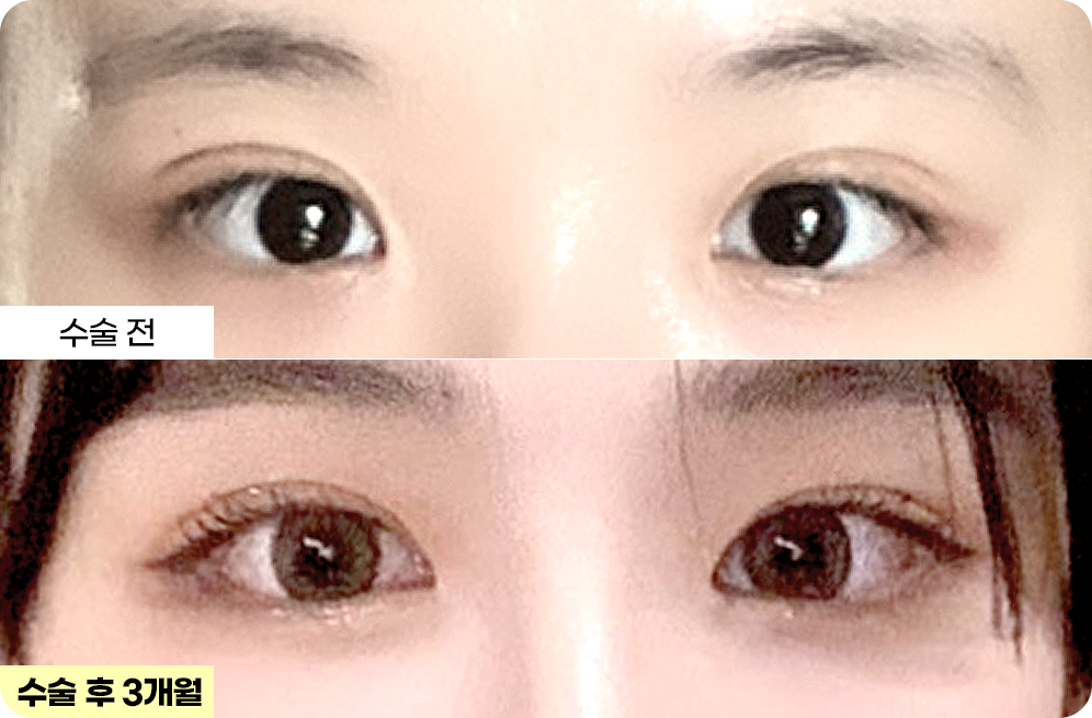 디에이 눈매 교정