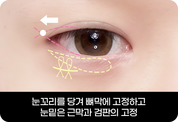 디에이 눈매확장트임