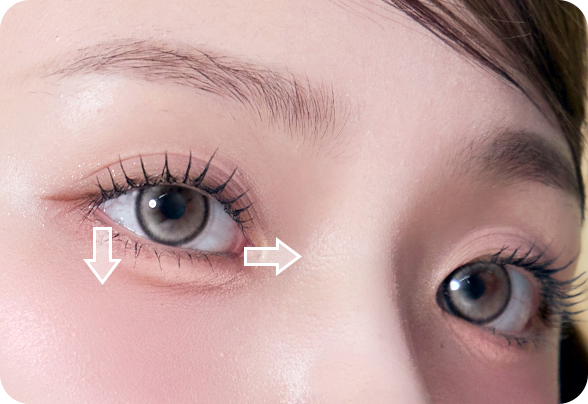 디에이 눈매확장트임