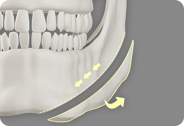 디에이 노핀윤곽
