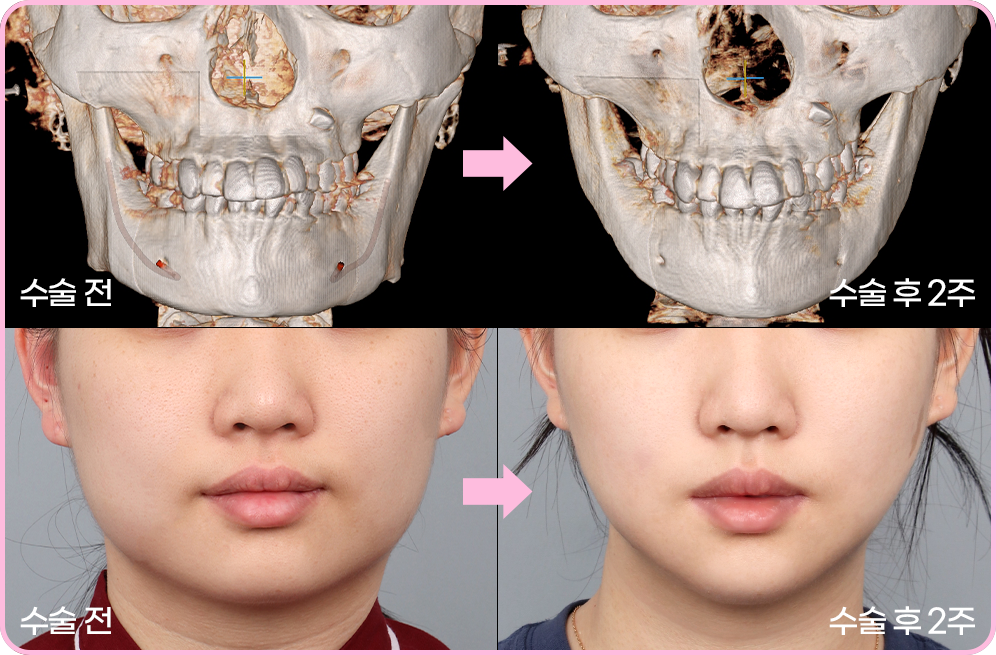 디에이 노핀윤곽