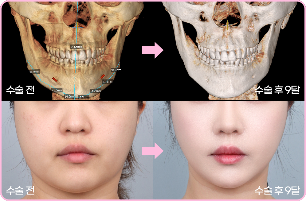 디에이 노핀윤곽