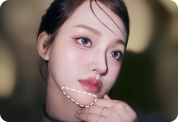 디에이 보형물윤곽