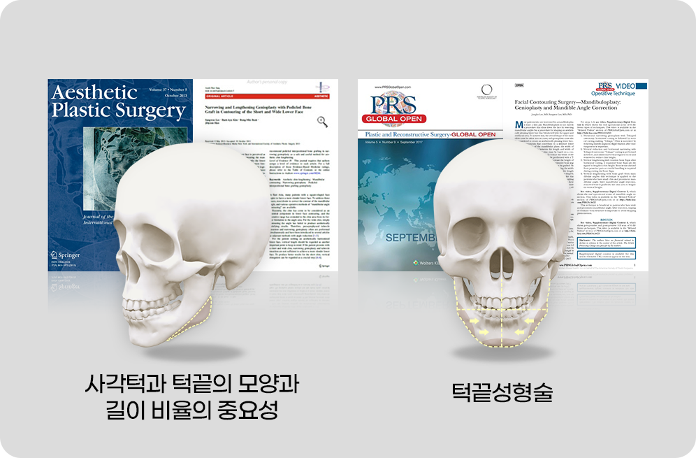 디에이 사각턱수술