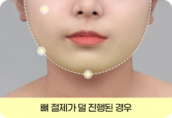 실패 없는 디에이 안면윤곽 재수술