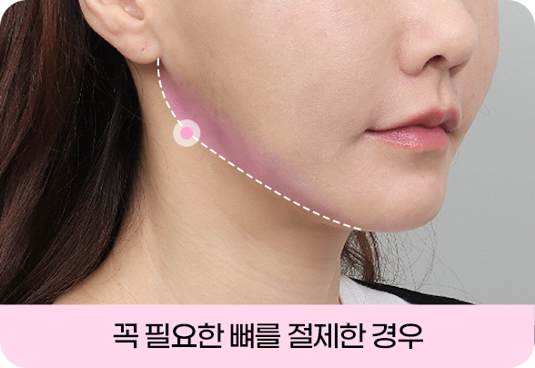 디에이 안면윤곽 재수술