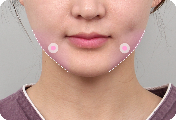 안면윤곽 재수술 뼈절제 케이스