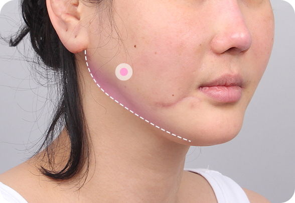 디에이 안면윤곽 턱 모양 재건 수술