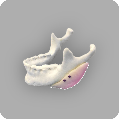 구현된 뼈 모양에 맞춰 재건 부위 제작