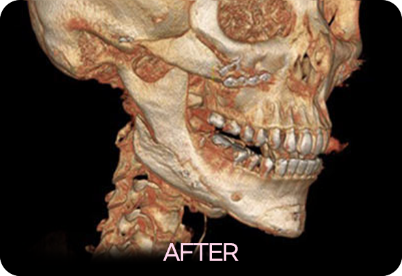 디에이 안면윤곽 재수술