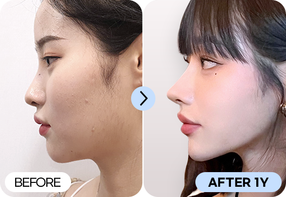 다다코성형