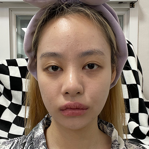 수술 전 (1)_500.jpg