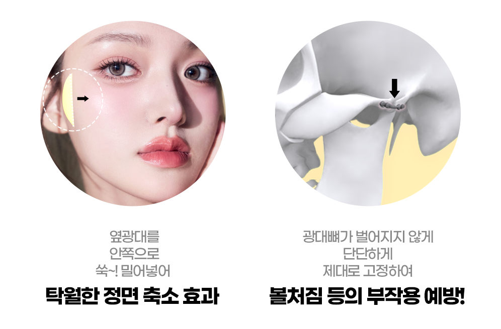 안면윤곽수술 효과1