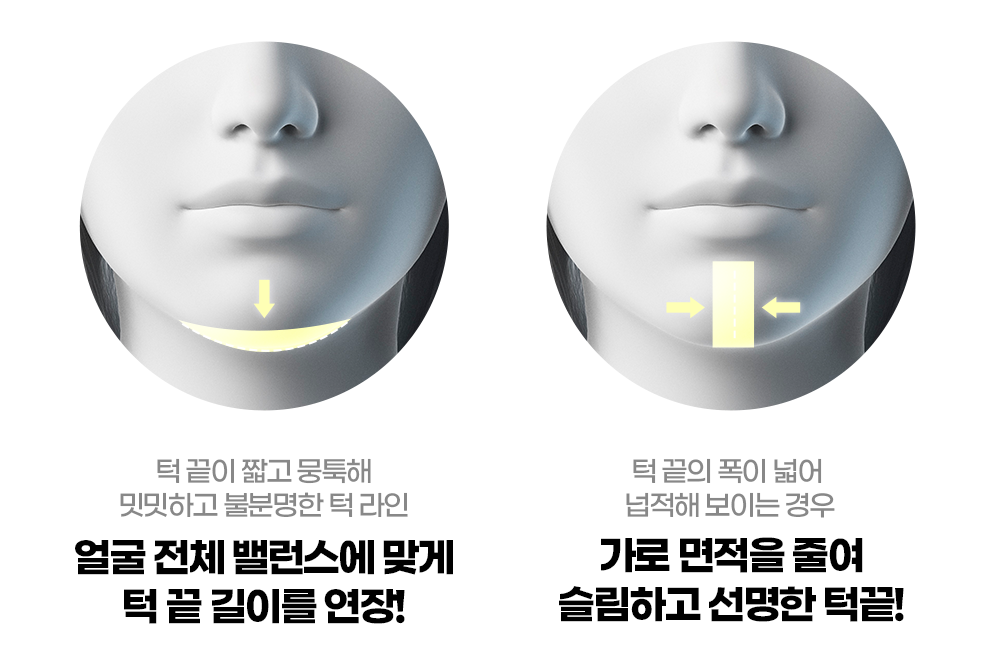 턱끝성형 효과2